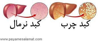 عوامل اصلی کبد چرب را بشناسیم