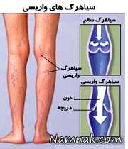 واریس چیست و چگونه می‌توان برطرفش کرد؟